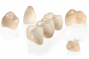 1日で白い歯を――セレックシステム